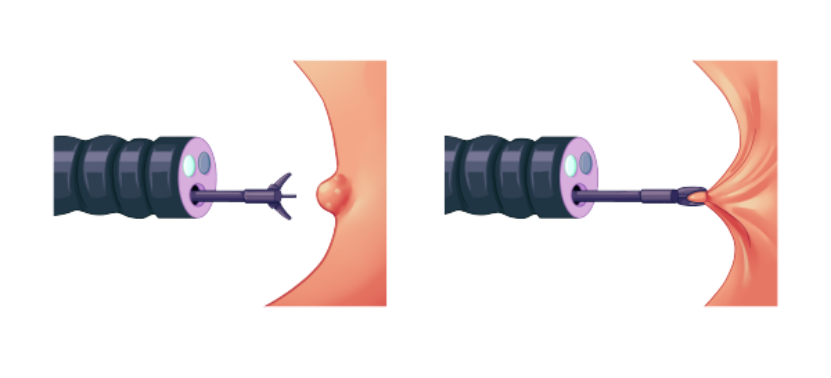 Endoscopy World, Gastrointestinal Mucosal Biopsy Tools